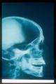 Lateral head x-ray of Rameses III.